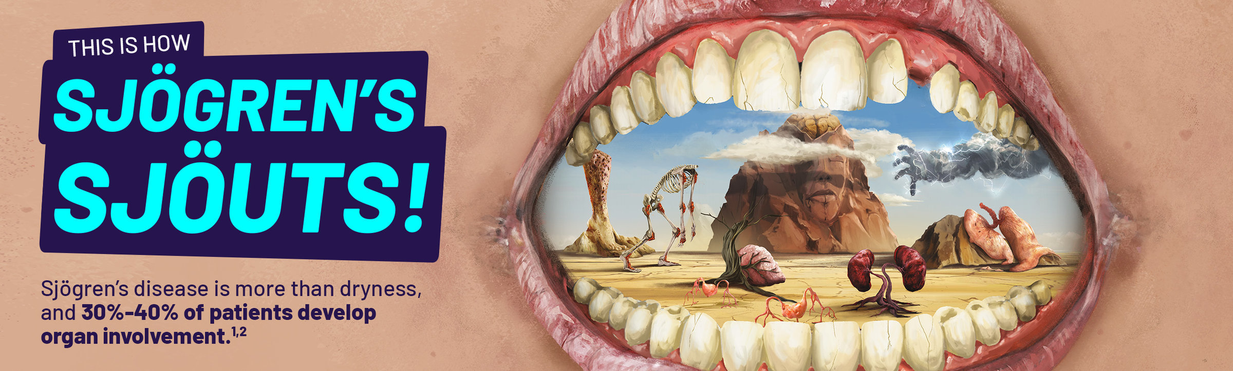 This is how Sjögren's Sjöuts! Sjögren's disease is more than dryness, and 30%-40% of patients develop organ involvement.